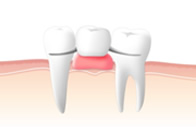 入れ歯 義歯 のイメージ